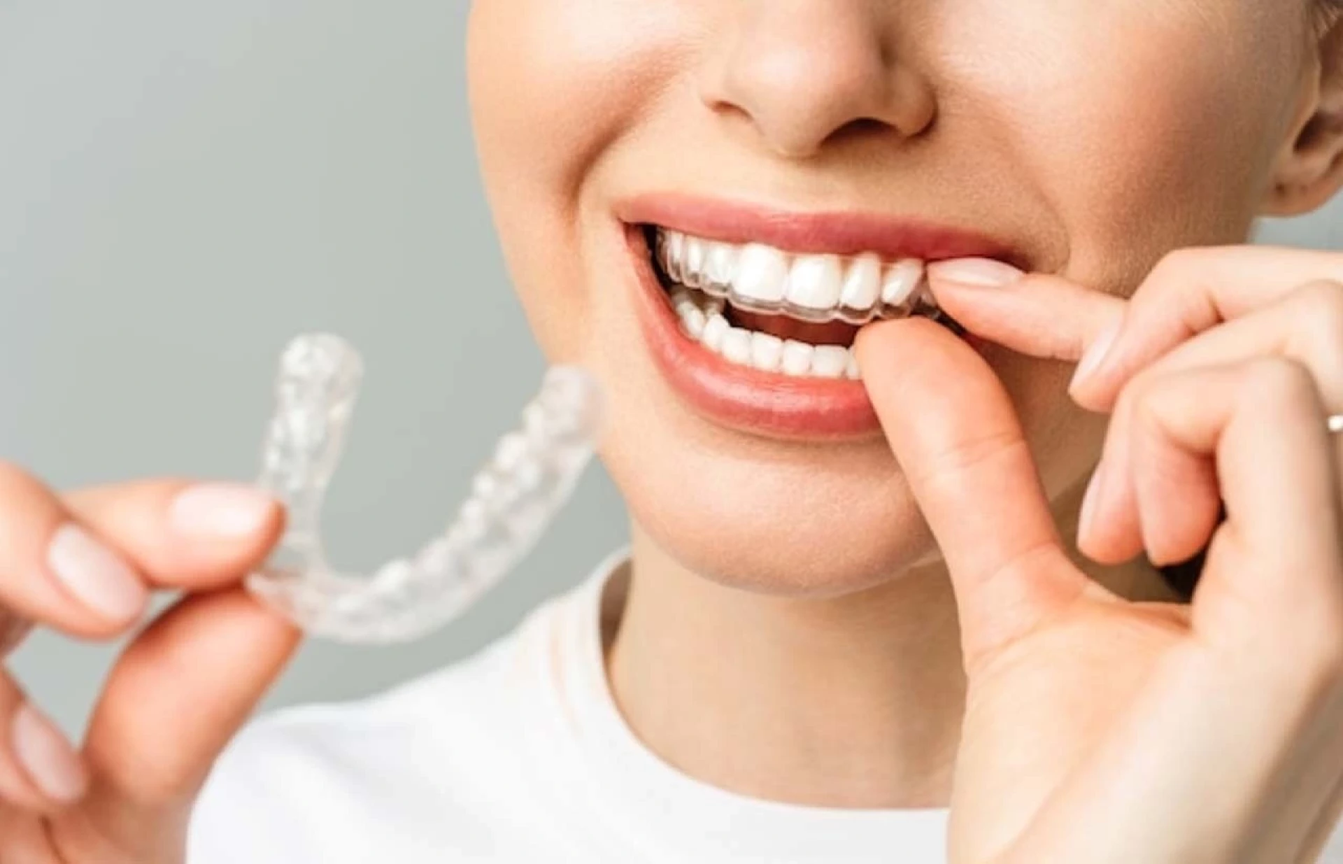 Do Clear Aligners Really Work for Teeth Straightening? i3D Liner Blog