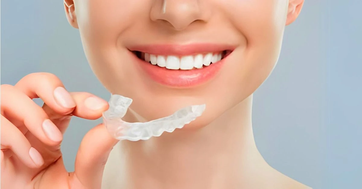 Benefits of Clear Aligner