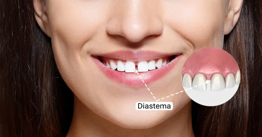 Diastema