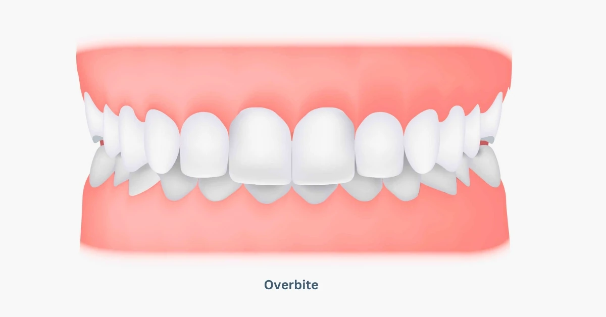 What is Overbite