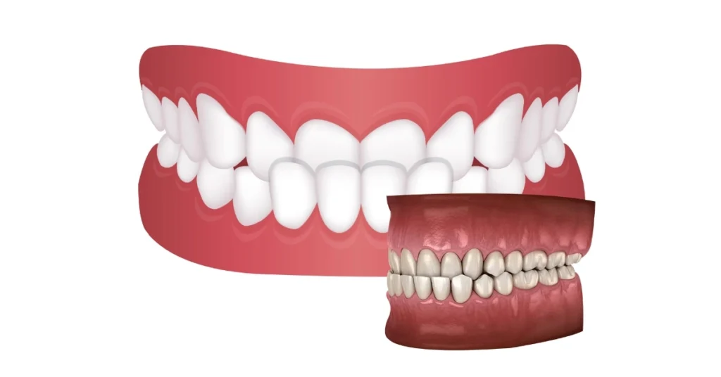 Underbite Symptoms, Causes, and Treatment
